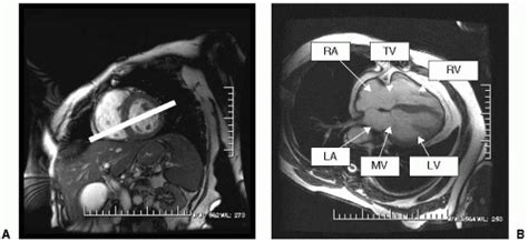 Cardiovascular Magnetic Resonance Imaging Positioning Radiology Key