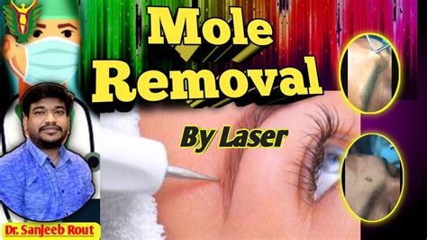 Mole Removal By Lasers Dr Sanjeeb Rout Youtube