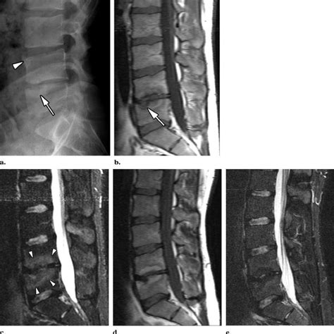 Spondylodiskitis Inflammatory Andersson Lesions In A 24 Year Old