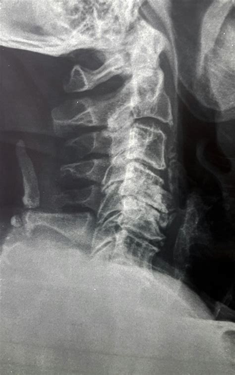Cervical Spine Anatomy Spine Orthobullets
