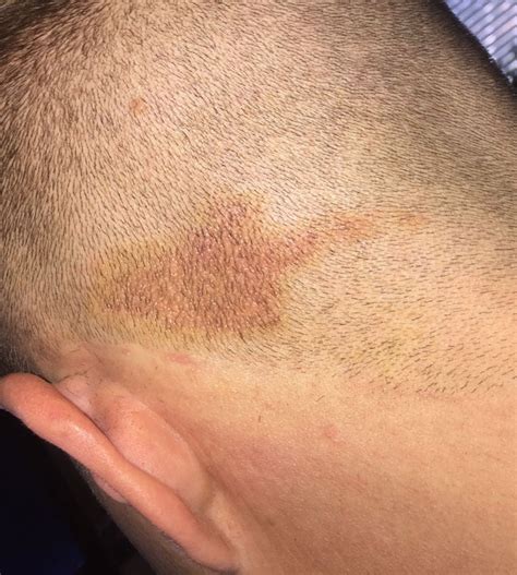 Any Advice About This Rash On My Scalp Psoriasis