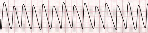Ventricular Tachycardia Vs Ventricular Fibrillation On An Ecg