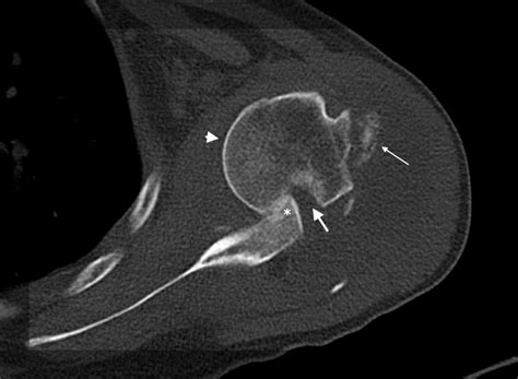 Cureus Management Of Neglected Locked Anterior Dislocation Of