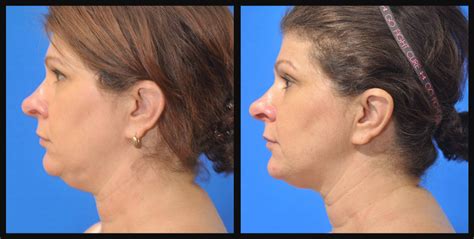 Coolsculpting For Double Chin Dr Dean Kane Center For Cosmetic