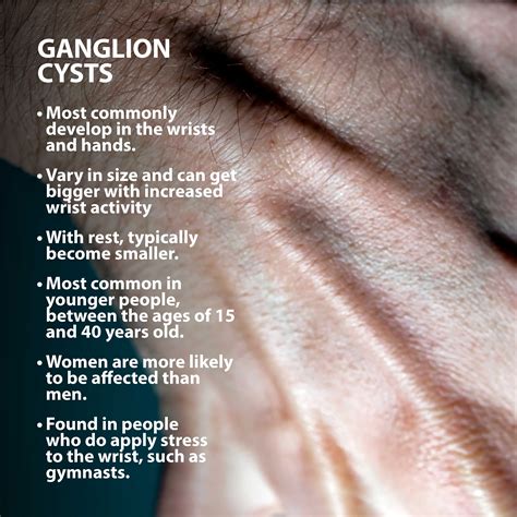 How Do I Get Rid Of A Ganglion Cyst On My Knee Brandon Martin Kapsels