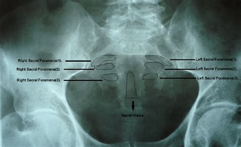 Anteroposterior View Of Male Pelvic Radiograph Showing Sacral Hiatus