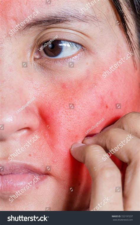 Face Young Woman Itching Red Rash Stock Photo 722197237 Shutterstock