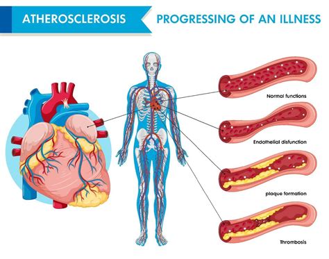 Atherosclerosis Progression Of An Illness 7539786 Vector Art At Vecteezy
