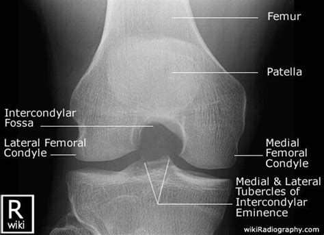 Ap Knee Anatomy Radiology Student Radiography Student Medical Knowledge