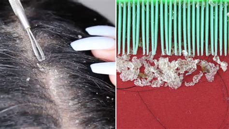 Dandruff Scraping Could Be The New Pimple Popping