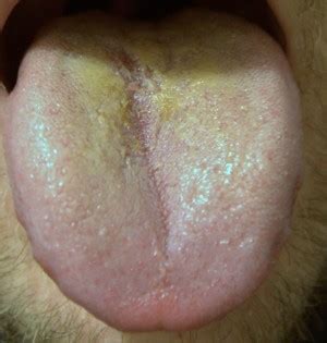 Ordinarily, yellow tongue is a harmless condition that causes a thick, yellowish coating on the tongue. Burnt Tongue Quotes. QuotesGram
