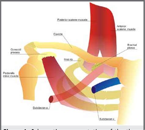 Figure 1 From Arterial Thoracic Outlet Syndrome Semantic Scholar