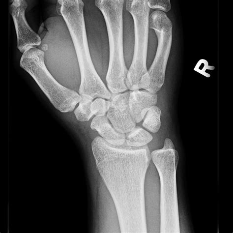Scaphoid Fracture Image
