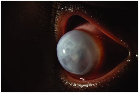 Acute Corneal Hydrops In A Young Man Cornea Jama Ophthalmology