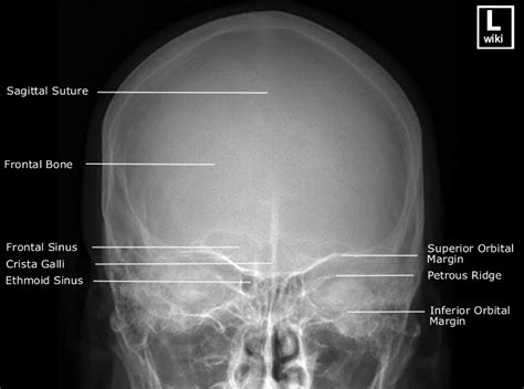 Mundo Da Radiologia Incidência Pa Crânio