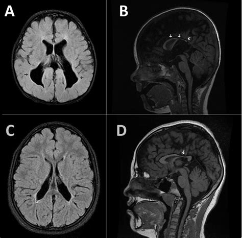 We did not find results for: Periventricular Leukomalacia. Sequalae findings in two ...