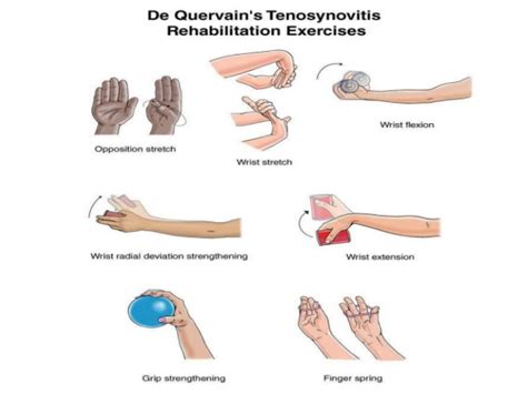 Learn about de quervain's tenosynovitis symptoms, treatment, prognosis, and diagnosis with the finkelstein maneuver test. DE QUERVAIN TENOSYNOVITIS EXERCISES PDF