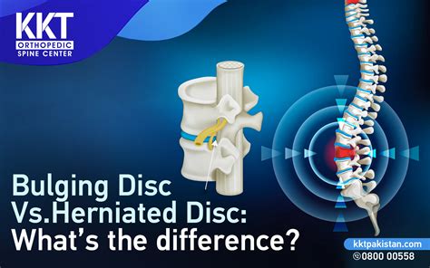 Bulging Disc Vs Herniated Disc Whats The Difference Testingform