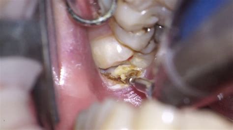Operculectomy Of Mn 3dr Molar Youtube