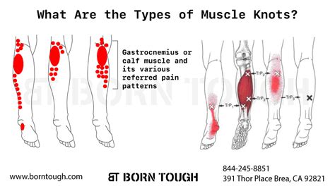 Calf Muscle Knots All You Need To Know About These Painful Lumps