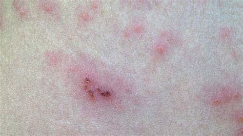 Jujus Lupus Is It Shingles Or One Of My Cutaneous Porphyria Rashes