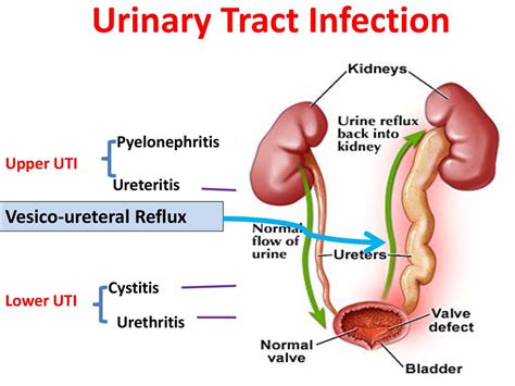 Urinary Tract Infections Causes Types Risk Factors Upper Uti Pyelonephritis Lower Uti