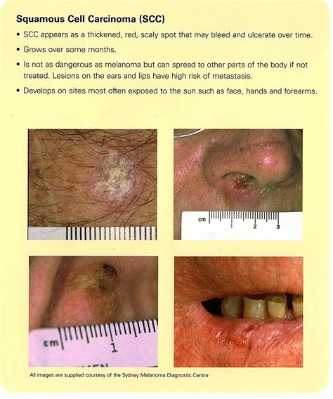 Squamous Cell Carcinoma Ear Pictures