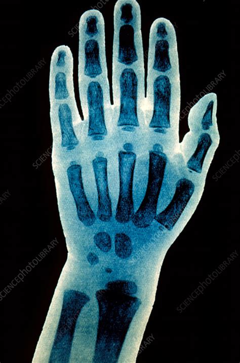 Childs Hand X Ray Stock Image P1160449 Science Photo Library