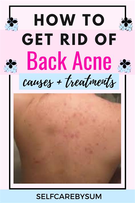 How To Get Rid Of Back Acne Once And For All Self Care By Sum Back