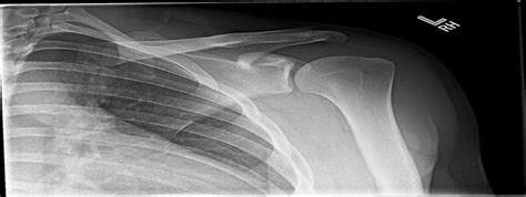 Image Quiz Paralabral Shoulder Cyst Jbjs Journal Of Orthopaedics For