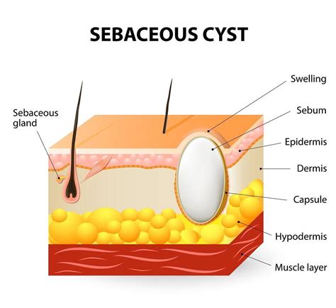 When Are Sebaceous Cysts Cause For Concern Lakeland Surgical Clinic