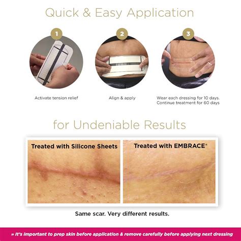 Embrace Scar Treatment Silicone Sheets For New Scars With Active Scar