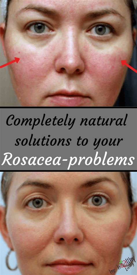 Rosacea Rosacea Remedies Rosacea Remedies Essential Oils Rosacea
