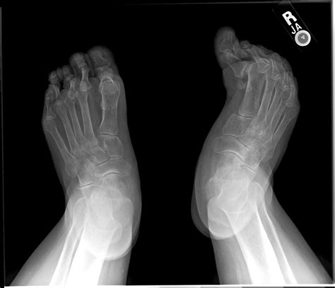 Rheumatoid Arthritis With Tibial Deviation Of The Toes Image