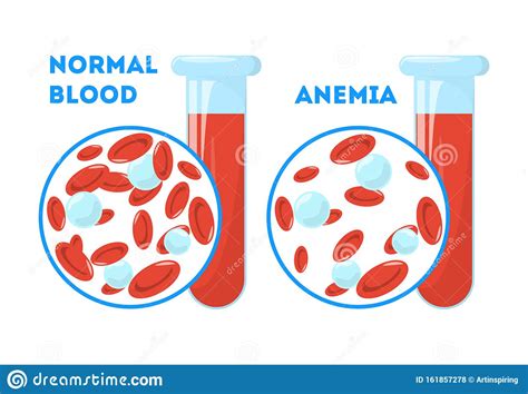 Anemia Symptoms Icons Set Medical And Healtcare Concept Editable