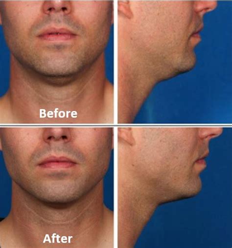 Kybella Submental Fat Removal Injections