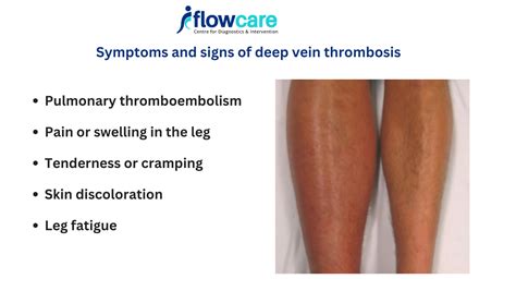 Symptoms And Signs Of Deep Vein Thrombosis Treatment