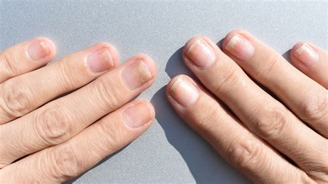 Onycholiza paznokci jakie są jej przyczyny i jak ją leczyć