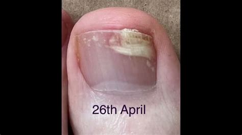 Fungal Nail Treatment With Lamisil Tablets Terbinafine Onychomycosis