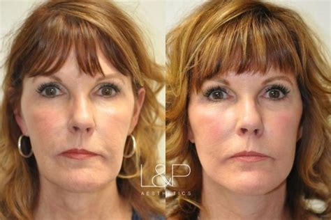 Facelift And Neck Lift Before And After Photos Case 40 Palo Alto And San