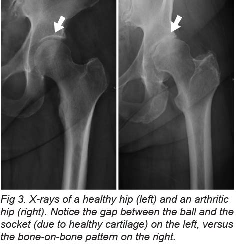 Arthritis Of The Hip Joint Mu Health Care