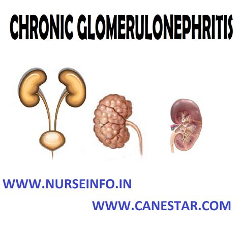 Chronic Glomerulonephritis Nurse Info