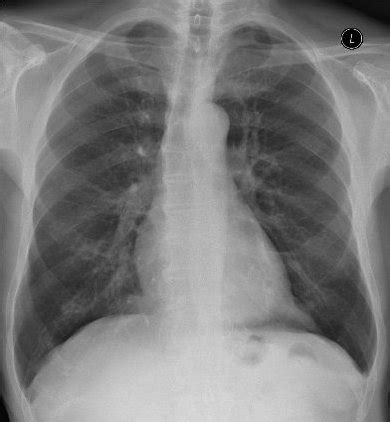 Embolie je obvykle odvozena z hlubokých žil dolních končetin a pánve a způsobuje embolii cirkulací do plicní tepny. Kazuistika PNE-54: Čerstvá levostranná plicní embolie