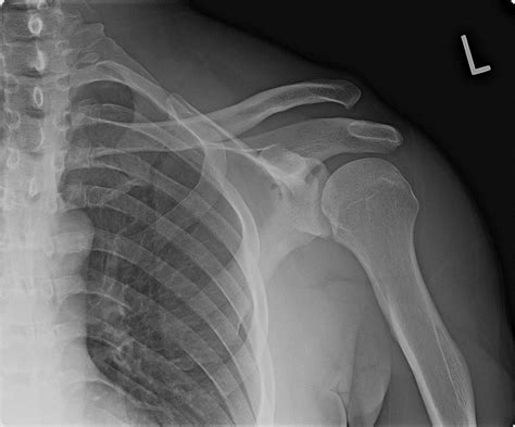 28 Year Old Male With Pain In Shoulder After Fall Journal Of Urgent