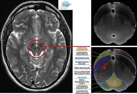 Midbrain Pons And Medulla Anatomy And Syndromes Radiographics