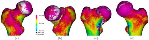 Cortical Thickness Estimation For An 87 Year Old Male Volunteer With A