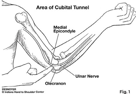 Cubital Tunnel Syndrome Patient Education Ihtsc