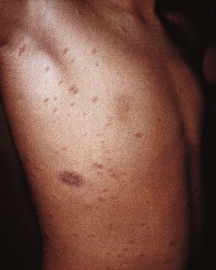 Consult a doctor for medical advice. Pityriasis Rosea | Anesthesia Key