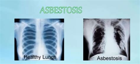 Asbestosis Enfermedad Laboral En Colombia Caso