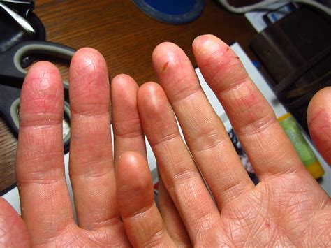 Extremely Dry Cracked Hands Medotp